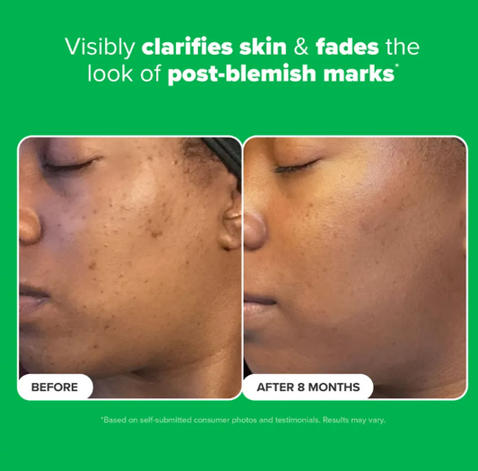 10% Azelaic Acid Booster 30ML