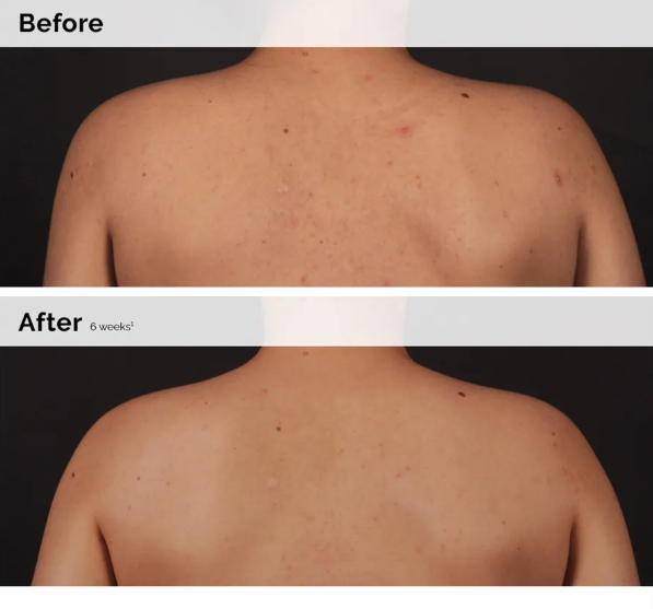 Salicylic Acid 0.5% Body Serum 240ML