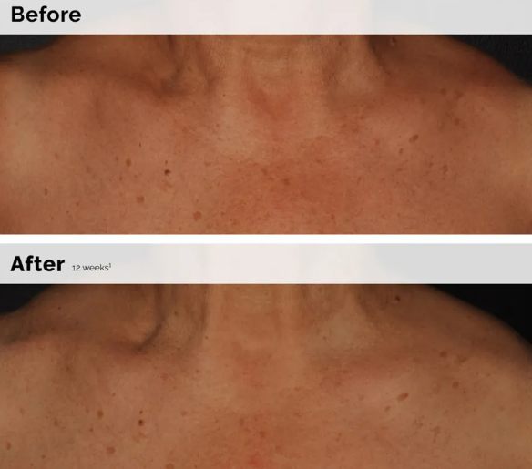 The Ordinary Niacinamide 5% Face And Body Emulsion