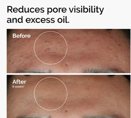 The Ordinary Niacinamide 10% + Zinc 1% 30mL